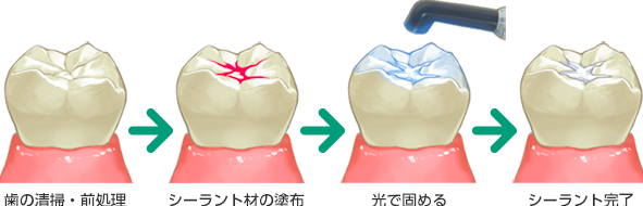 シーラント