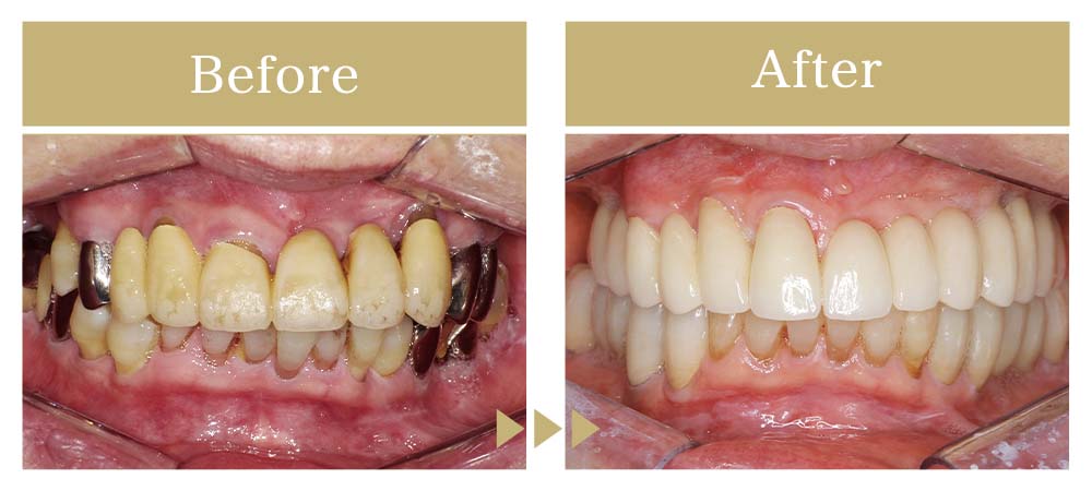 インプラントの症例ビフォーアフター