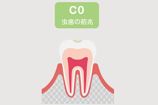 虫歯C0